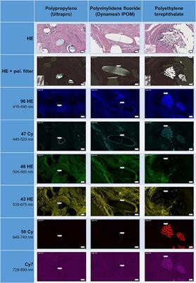 Quantitative Characterization of Macrophage, Lymphocyte, and Neutrophil Subtypes Within the Foreign Body Granuloma of Human Mesh Explants by 5-Marker Multiplex Fluorescence Microscopy